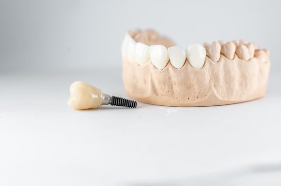 Close-up on plaster model of artificial jaw and dental implant on the white background. Concept of prosthetics and implantation in dentistry